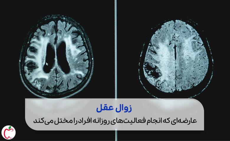 توصیه محققان به زنان برای کاهش احتمال زوال عقل