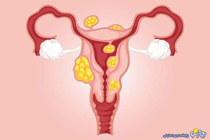 فیبروم رحم چیست و راه‌های درمان آن کدامند؟